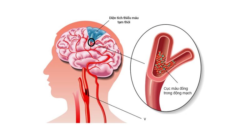 Đột Quỵ Là Gì